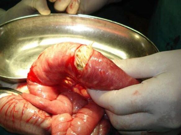 Worms are dangerous
