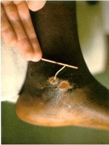 A guinea worm is removed from the leg of a person suffering from dracunculosis